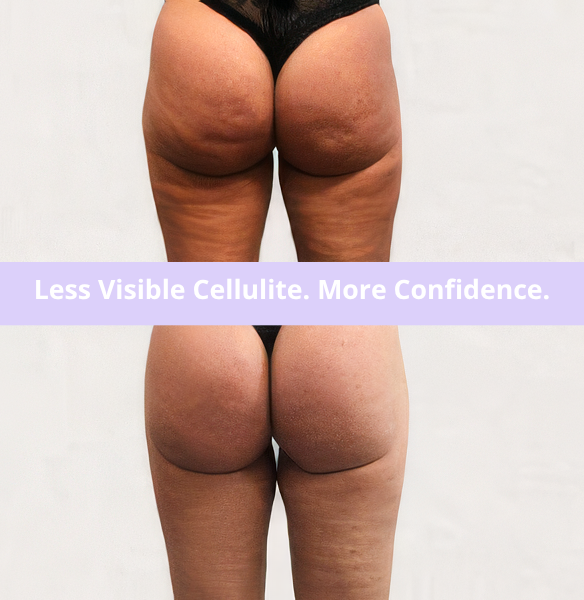 Anti-Cellulite Smoothing Massage Oil